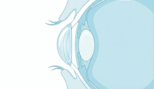 Illustration: Kein Verrutschen der Kontaktlinsen hinter das Auge